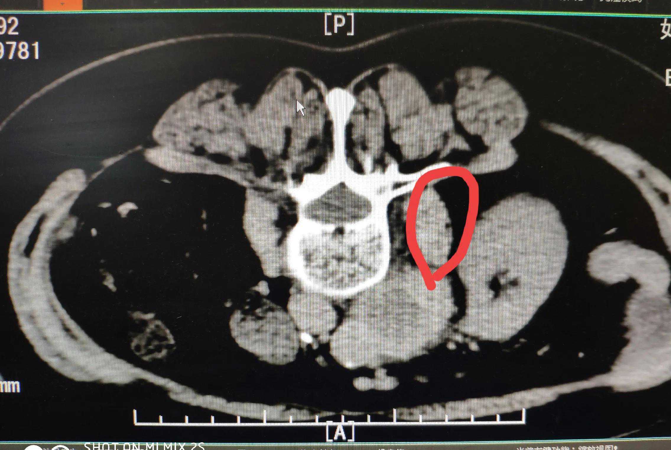 左上腹融合淋巴结，穿刺活检能明确诊断吗？